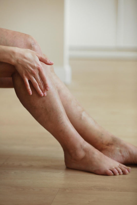 FAQs about Vein Removal