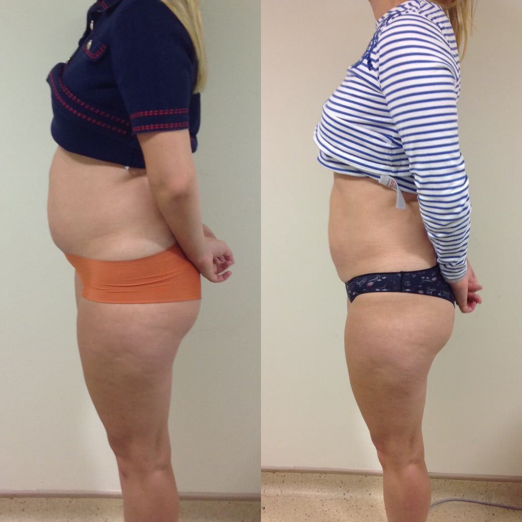 Promax lipo before and after