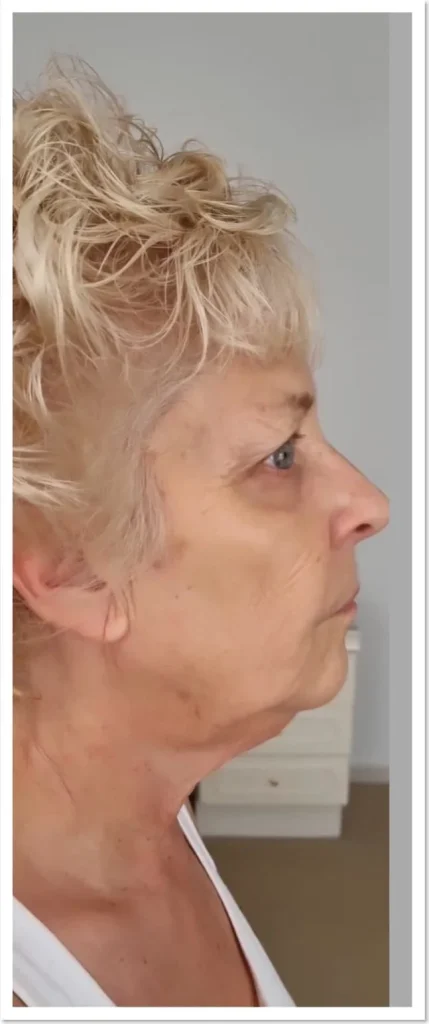 The same face and jawline after Focus Dual treatment