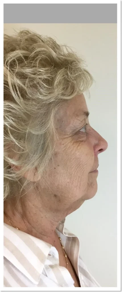 Face and jawline in profile before Focus Dual treatment