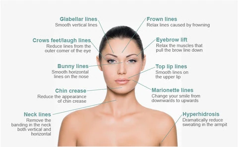 diagram of botox